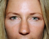 Feel Beautiful - Eyelid Surgery San Diego Case 41 - After Photo